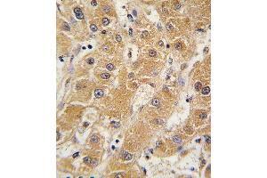 Formalin-fixed and paraffin-embedded human hepatocarcinoma tissue reacted with OA5 antibody (N-term) 7412a , which was peroxidase-conjugated to the secondary antibody, followed by DAB staining. (APOA5 antibody  (N-Term))