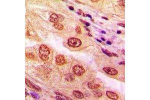 Immunohistochemical analysis of CaMK4 staining in human lung cancer formalin fixed paraffin embedded tissue section. (CAMK4 antibody)