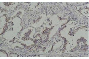 Immunohistochemistry of paraffin-embedded Human breast carcinoma tissue with Phosphotyrosine Monoclonal Antibody at dilution of 1:200 (Phosphotyrosine antibody)