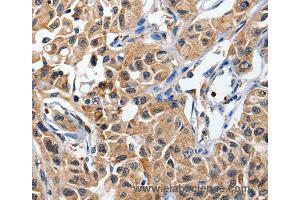 Immunohistochemistry of Human lung cancer using DUSP8 Polyclonal Antibody at dilution of 1:40