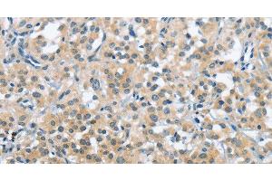 Immunohistochemistry of paraffin-embedded Human thyroid cancer tissue using TRDMT1 Polyclonal Antibody at dilution 1:40 (Dnmt2 antibody)