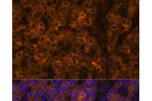 Immunofluorescence analysis of Human liver cancer using TTR Polyclonal Antibody at dilution of 1:100 (40x lens). (TTR antibody)