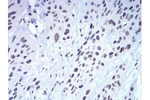 Immunohistochemical analysis of paraffin-embedded esophageal cancer tissues using CBX5 mouse mAb with DAB staining.