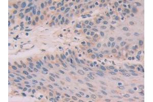 DAB staining on IHC-P; Samples: Human Stomach cancer Tissue (IL-33 antibody  (AA 1-270))