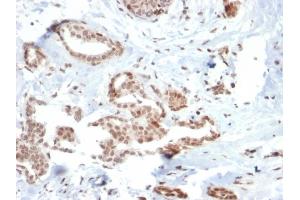Formalin-fixed, paraffin-embedded human Breast Carcinoma stained with SOX4 Mouse Monoclonal Antibody (SOX4/2540). (SOX4 antibody)