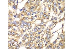 Immunohistochemistry of paraffin-embedded Human esophageal cancer using VTI1B Polyclonal Antibody at dilution of 1:100 (40x lens). (VTI1B antibody)