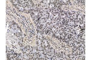 ABIN7096400 and ABIN7100464 at 1/100 staining human lung cancer by IHC-P.