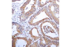 Immunohistochemical analysis of Aldose Reductase staining in human colon cancer formalin fixed paraffin embedded tissue section. (AKR1B1 antibody  (C-Term))
