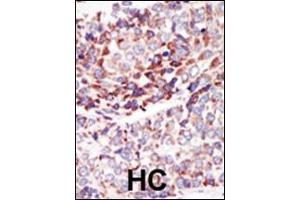 Formalin-fixed and paraffin-embedded human cancer tissue reacted with the primary antibody, which was peroxidase-conjugated to the secondary antibody, followed by AEC staining. (TEK antibody  (C-Term))