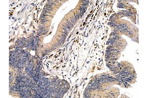 ABIN7094682 and ABIN7098733 at 1/100 staining Human colorectal cancer by IHC-P. (DMBT1 antibody  (C-Term))