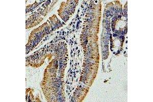 Immunohistochemical analysis of GNAI3 staining in human colon cancer formalin fixed paraffin embedded tissue section.
