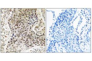 Immunohistochemistry analysis of paraffin-embedded human lung carcinoma tissue, using TSEN54 antibody. (TSEN54 antibody  (Internal Region))