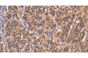 Immunohistochemistry of paraffin-embedded Human gasrtic cancer tissue using GCSAM Polyclonal Antibody at dilution 1:40 (GCET2 antibody)