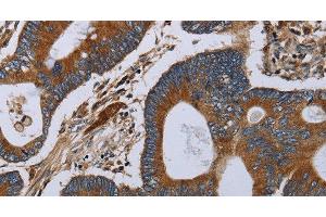 Immunohistochemistry of paraffin-embedded Human colon cancer tissue using MT-ND6 Polyclonal Antibody at dilution 1:40 (MT-ND6 antibody)