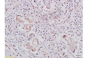 Formalin-fixed and paraffin-embedded human lung carcinoma tissue labeled with Rabbit Anti-IGF1R/CD221 Polyclonal Antibody, Unconjugated  at 1:300 followed by conjugation to the secondary antibody and DAB staining (IGF1R antibody  (AA 251-350))