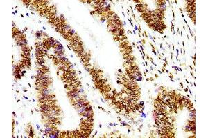 IHC image of ABIN7127295 diluted at 1:100 and staining in paraffin-embedded human colon cancer performed on a Leica BondTM system. (Recombinant HIST1H3A antibody)