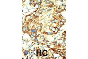 Formalin-fixed and paraffin-embedded human hepatocellular carcinoma tissue reacted with the primary antibody, which was peroxidase-conjugated to the secondary antibody, followed by DAB staining. (Dnmt2 antibody  (AA 353-383))