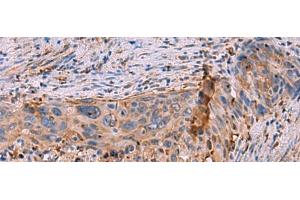 Immunohistochemistry of paraffin-embedded Human cervical cancer tissue using KBTBD11 Polyclonal Antibody at dilution of 1:35(x200) (KBTBD11 antibody)