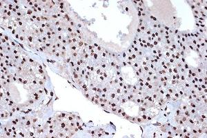 Immunohistochemistry of paraffin-embedded human liver cancer using macroH2A. (H2AFY antibody)