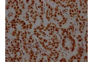 IHC image of ABIN7127643 diluted at 1:100 and staining in paraffin-embedded human breast cancer performed on a Leica BondTM system. (Recombinant NONO antibody)