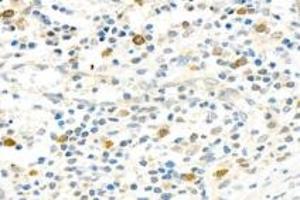 Immunohistochemistry analysis of paraffin-embedded human appendix using,PARP1 (ABIN7075114) at dilution of 1: 750 (PARP1 antibody  (cleaved))