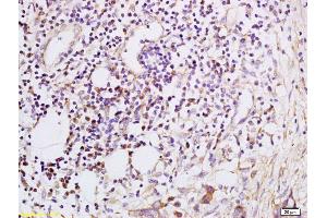 Formalin-fixed and paraffin embedded Human esophageal carcinoma labeled with Anti-CXCL5 Polyclonal Antibody, Unconjugated (ABIN741900) at 1:200, followed by conjugation to the secondary antibody and DAB staining