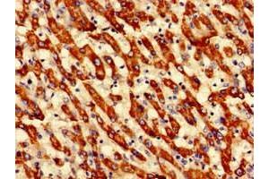 Immunohistochemistry of paraffin-embedded human liver cancer using ABIN7149659 at dilution of 1:100 (ECH1 antibody  (AA 36-135))