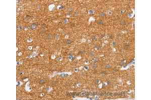 Immunohistochemistry of Human thyroid cancer using SNCA Polyclonal Antibody at dilution of 1:30 (SNCA antibody)