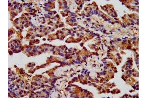 IHC image of ABIN7161356 diluted at 1:400 and staining in paraffin-embedded human lung cancer performed on a Leica BondTM system.