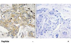 Immunohistochemistry analysis of paraffin-embedded human breast carcinoma tissue, using TM4SF1 polyclonal antibody . (TM4SF1 antibody)