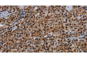 Immunohistochemistry of paraffin-embedded Human thyroid cancer tissue using DCAF6 Polyclonal Antibody at dilution 1:30 (DCAF6 antibody)