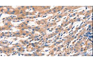 Immunohistochemistry of paraffin-embedded Human liver cancer using RAB18 Polyclonal Antibody at dilution of 1:300 (RAB18 antibody)
