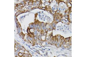 Immunohistochemistry of paraffin-embedded human lung cancer using IL18R1/IL-18 R alpha Rabbit pAb (ABIN3023690, ABIN3023691, ABIN3023692 and ABIN6219764) at dilution of 1:150 (40x lens).
