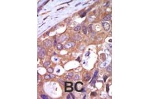 Formalin-fixed and paraffin-embedded human cancer tissue reacted with the primary antibody, which was peroxidase-conjugated to the secondary antibody, followed by AEC staining. (PKC mu antibody  (N-Term))