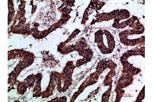 Immunohistochemical analysis of paraffin-embedded human-colon-cancer, antibody was diluted at 1:200.