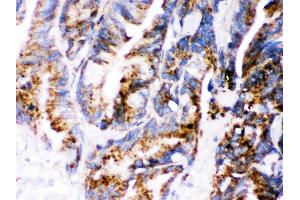 Cathepsin D was detected in paraffin-embedded sections of human Intestinal cancer tissues using rabbit anti- Cathepsin D Antigen Affinity purified polyclonal antibody at 1 μg/mL. (Cathepsin D antibody  (AA 201-412))