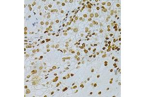Immunohistochemistry of paraffin-embedded human cancer using DKC1 Antibody (ABIN5970956) at dilution of 1/200 (40x lens). (DKC1 antibody)