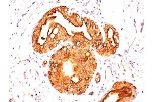 Formalin-fixed, paraffin-embedded human breast carcinoma stained with EMA antibody (MUC1/845). (MUC1 antibody)