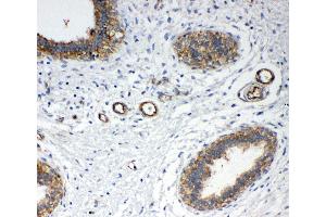 Anti-Annexin IV antibody,  IHC(P) IHC(P): Human Mammary Cancer Tissue (Annexin IV antibody  (N-Term))