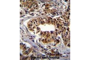 CAD Antibody (Center) immunohistochemistry analysis in formalin fixed and paraffin embedded human breast carcinoma followed by peroxidase conjugation of the secondary antibody and DAB staining.