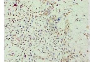 Immunohistochemistry of paraffin-embedded human breast cancer using ABIN7167947 at dilution of 1:100 (GRAF antibody  (AA 625-814))