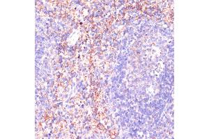 Immunohistochemistry of paraffin-embedded human colon carcinoma using Rap1A antibody (ABIN3021199, ABIN3021200, ABIN3021201 and ABIN6214062) at dilution of 1:100 (40x lens). (RAP1A antibody  (AA 50-150))