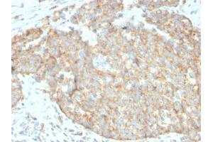 Formalin-fixed, paraffin-embedded human breast carcinoma stained with DR5 Mouse Monoclonal Antibody (DR5/3381). (TNFRSF10B antibody  (AA 266-393))