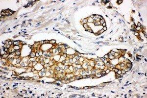 Anti-SPTLC1 antibody, IHC(P) IHC(P): Human Mammary Cancer Tissue (SPTLC1 antibody  (Middle Region))