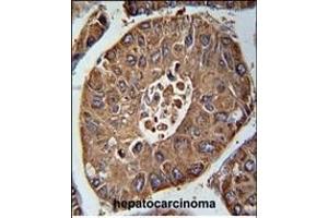 ACN9 Antibody (N-term) (ABIN655002 and ABIN2844636) immunohistochemistry analysis in formalin fixed and paraffin embedded human hepatocarcinoma followed by peroxidase conjugation of the secondary antibody and DAB staining. (ACN9 antibody  (N-Term))