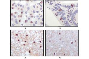 Immunohistochemical analysis of paraffin-embedded human liver carcinoma (A), recturn carcinoma (B), normal medulla tissue (C) and normal interbrain tissues (D), showing nuclear localization using Tip60 mouse mAb with DAB staining. (KAT5 antibody)