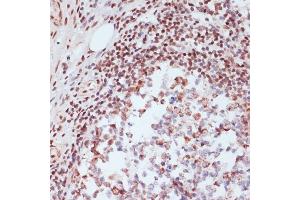 Immunohistochemistry of paraffin-embedded human colon carcinoma using Phospho-CREB1-S133 Rabbit pAb (ABIN3023522, ABIN3023523, ABIN3023524 and ABIN6225375) at dilution of 1:200 (40x lens). (CREB1 antibody  (pSer133))