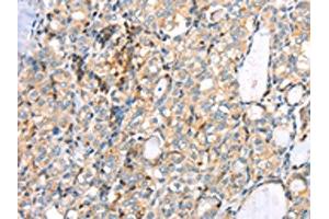 The image on the left is immunohistochemistry of paraffin-embedded Human thyroid cancer tissue using ABIN7191349(MAGEB2 Antibody) at dilution 1/40, on the right is treated with synthetic peptide. (MAGEB2 antibody)