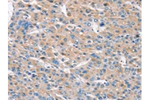 The image on the left is immunohistochemistry of paraffin-embedded Human liver cancer tissue using ABIN7192149(RASA3 Antibody) at dilution 1/30, on the right is treated with synthetic peptide. (RASA3 antibody)