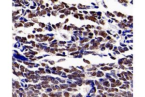 Immunohistochemistry analysis of paraffin-embedded human lung cancer using HDAC1 Polyclonal Antibody at dilution of 1:300. (HDAC1 antibody)